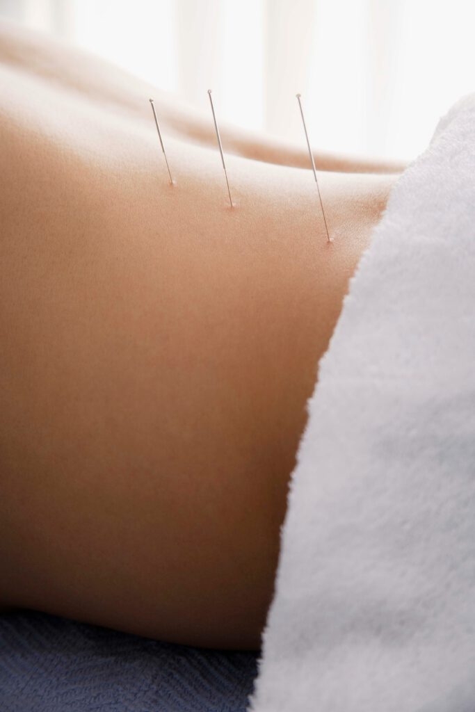 Lethbridge Acupuncture Back